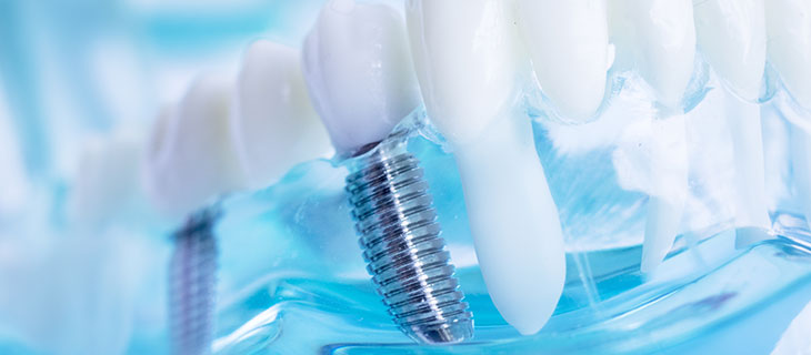 Missing Teeth Don’t Have to Be Lost Forever Missing Teeth Don’t Have to Be Lost Forever
