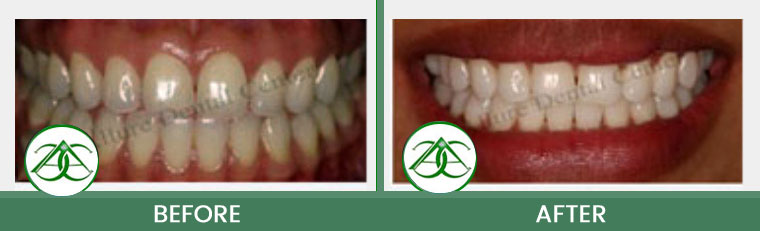 Smile Gallery of Allure Dental Center in Mountain View, CA