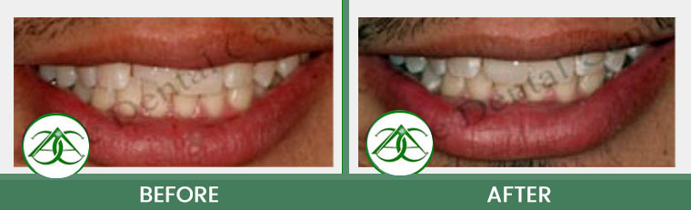 Smile Gallery of Allure Dental Center in Mountain View, CA