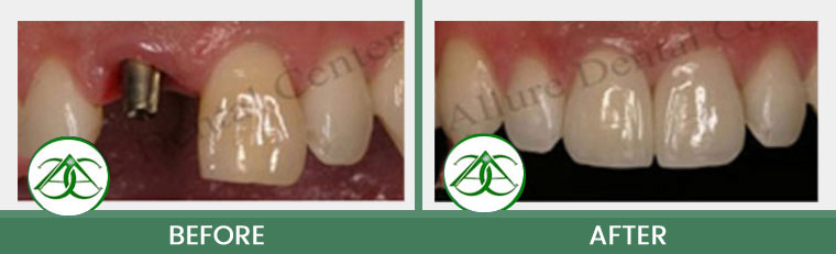 Smile Gallery of Allure Dental Center in Mountain View, CA