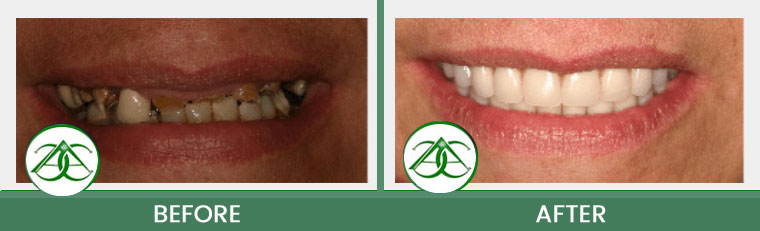 Smile Gallery of Allure Dental Center in Mountain View, CA