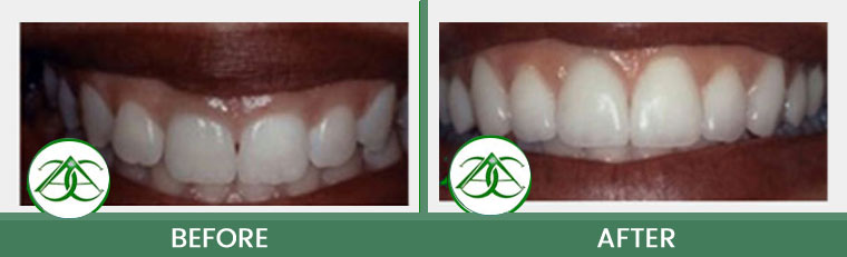 Smile Gallery of Allure Dental Center in Mountain View, CA
