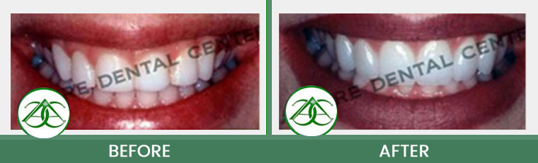 Smile Gallery of Allure Dental Center in Mountain View, CA