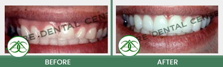 Smile Gallery of Allure Dental Center in Mountain View, CA