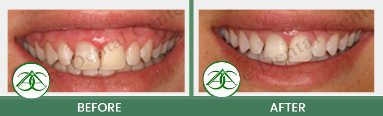 Smile Gallery of Allure Dental Center in Mountain View, CA