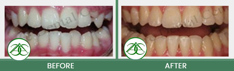Smile Gallery of Allure Dental Center in Mountain View, CA