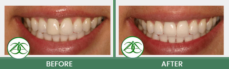 Smile Gallery of Allure Dental Center in Mountain View, CA