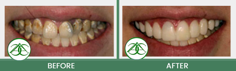 Smile Gallery of Allure Dental Center in Mountain View, CA