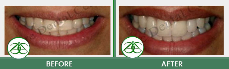 Smile Gallery of Allure Dental Center in Mountain View, CA