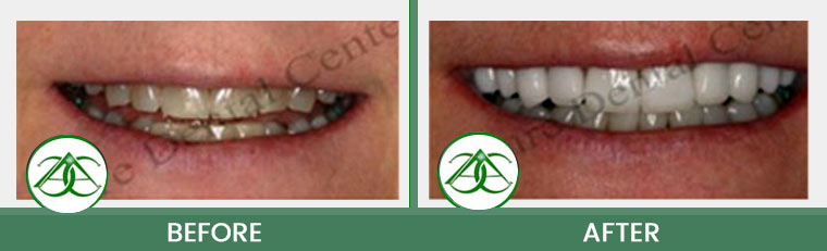 Smile Gallery of Allure Dental Center in Mountain View, CA