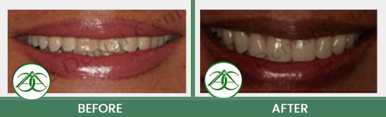 Smile Gallery of Allure Dental Center in Mountain View, CA