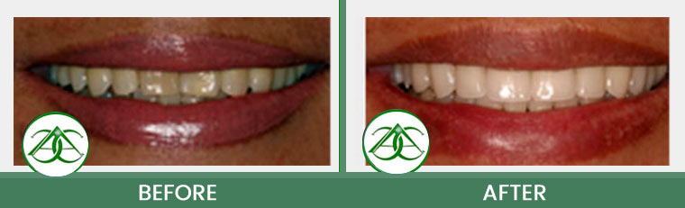 Smile Gallery of Allure Dental Center in Mountain View, CA