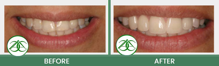 Smile Gallery of Allure Dental Center in Mountain View, CA