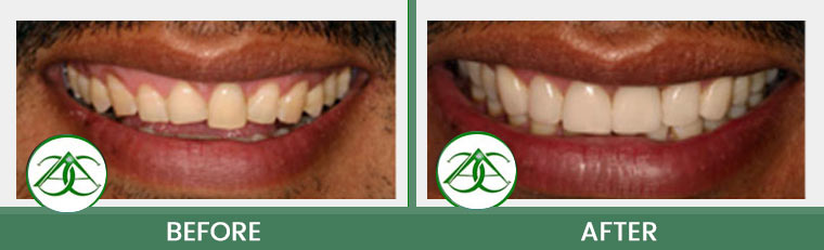 Smile Gallery of Allure Dental Center in Mountain View, CA