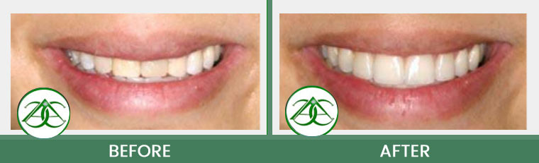 Smile Gallery of Allure Dental Center in Mountain View, CA