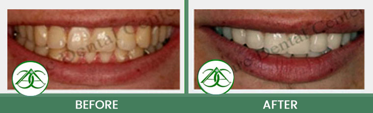 Smile Gallery of Allure Dental Center in Mountain View, CA