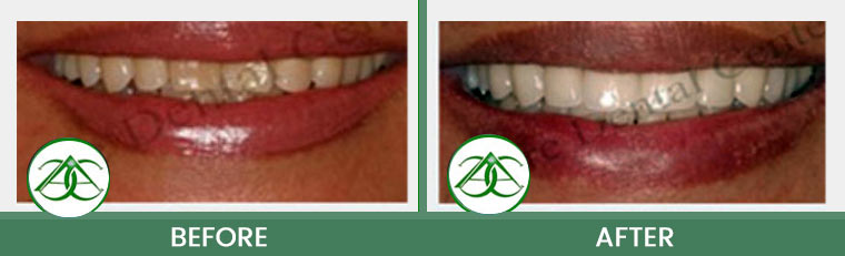 Smile Gallery of Allure Dental Center in Mountain View, CA