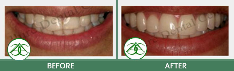 Smile Gallery of Allure Dental Center in Mountain View, CA