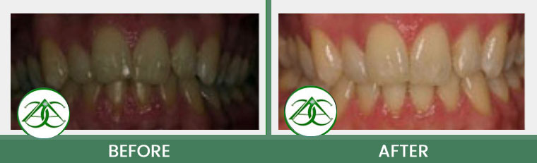 Smile Gallery of Allure Dental Center in Mountain View, CA