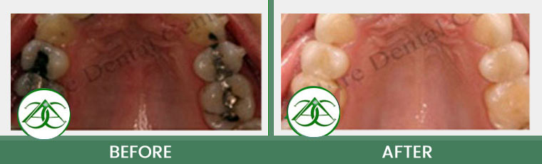 Smile Gallery of Allure Dental Center in Mountain View, CA