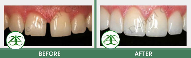 Smile Gallery of Allure Dental Center in Mountain View, CA