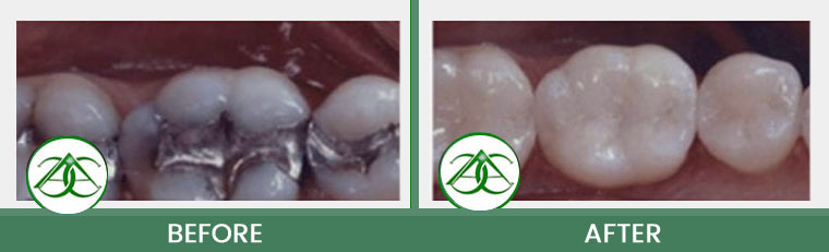 Smile Gallery of Allure Dental Center in Mountain View, CA