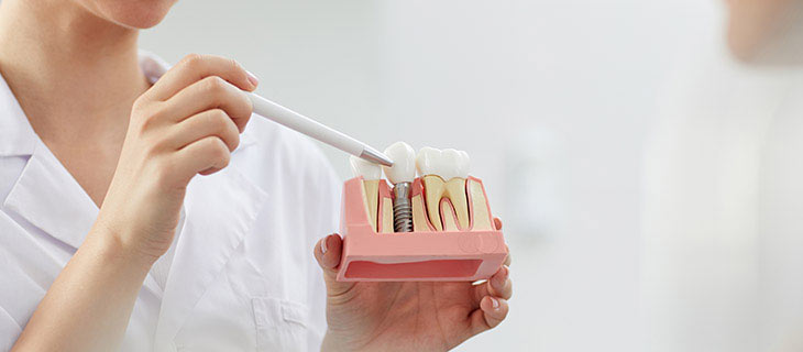 4 Questions to Ask About Dental Implants