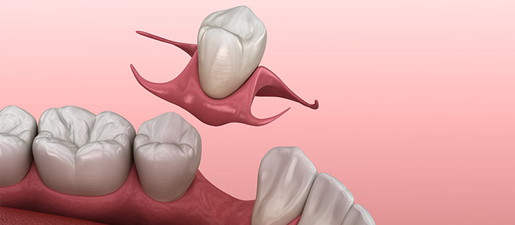 Removable Partial Dentures Near Me in Mountain View, CA Removable Partial Dentures Near Me in Mountain View, CA